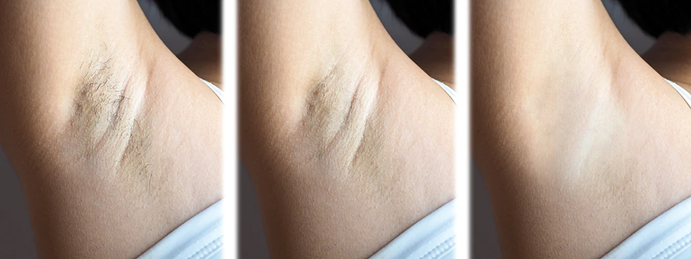 laser hair removal near me